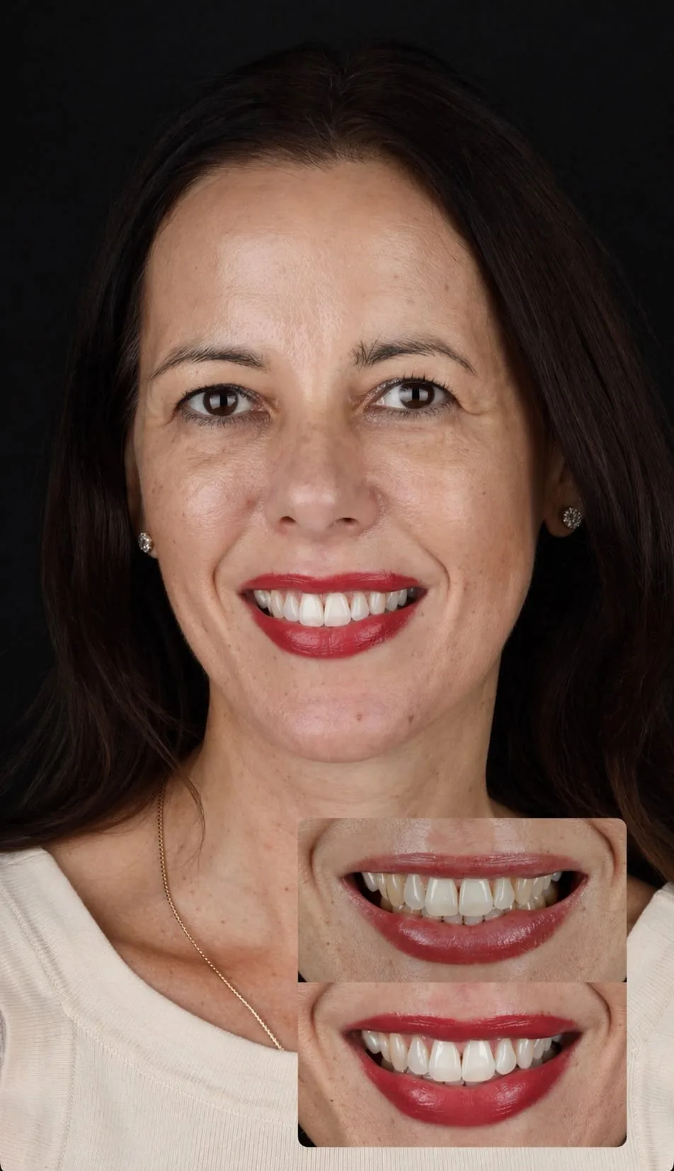 Clareamento dental - antes e depois