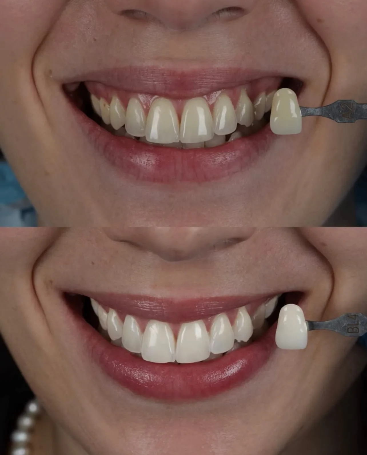 Clareamento dental - antes e depois