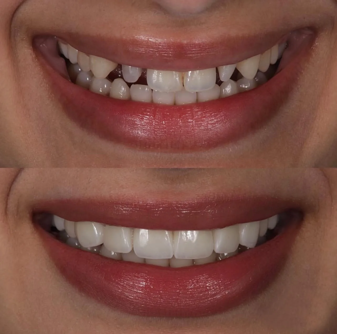 Lentes de contato dental - antes e depois