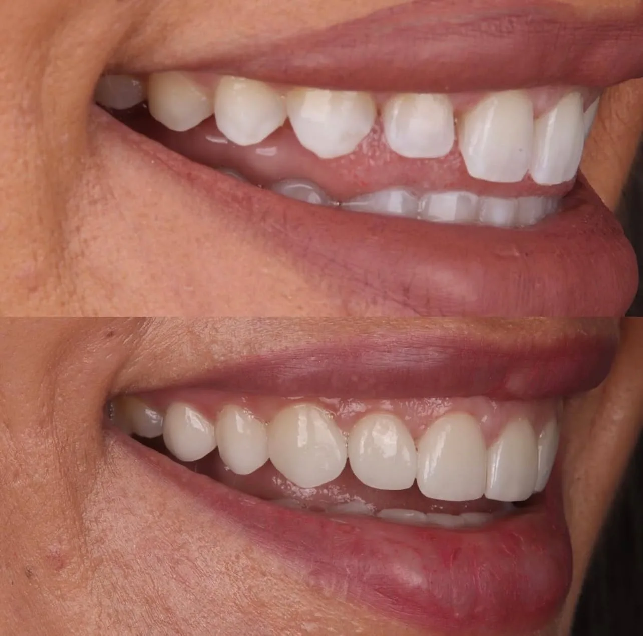 Lentes de contato dental - antes e depois