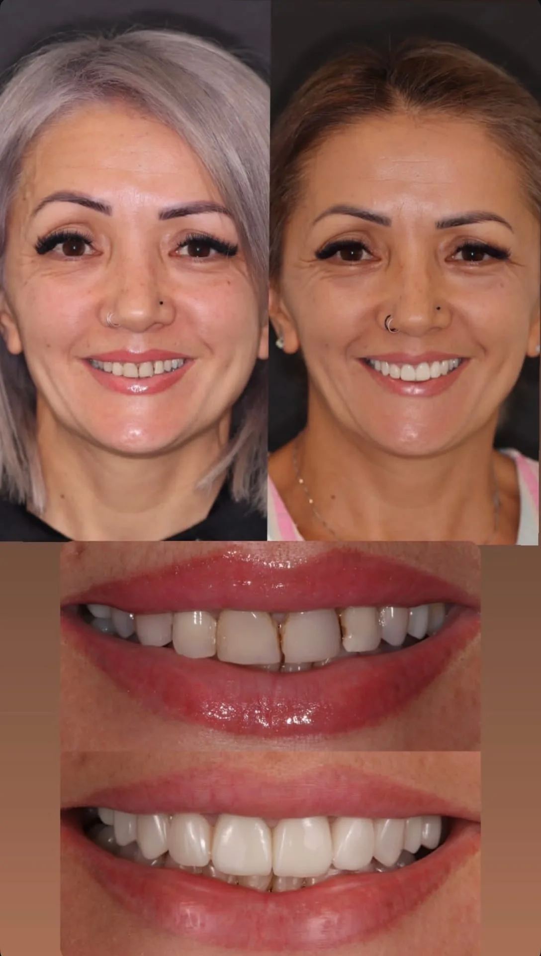 Lentes de contato dental - antes e depois