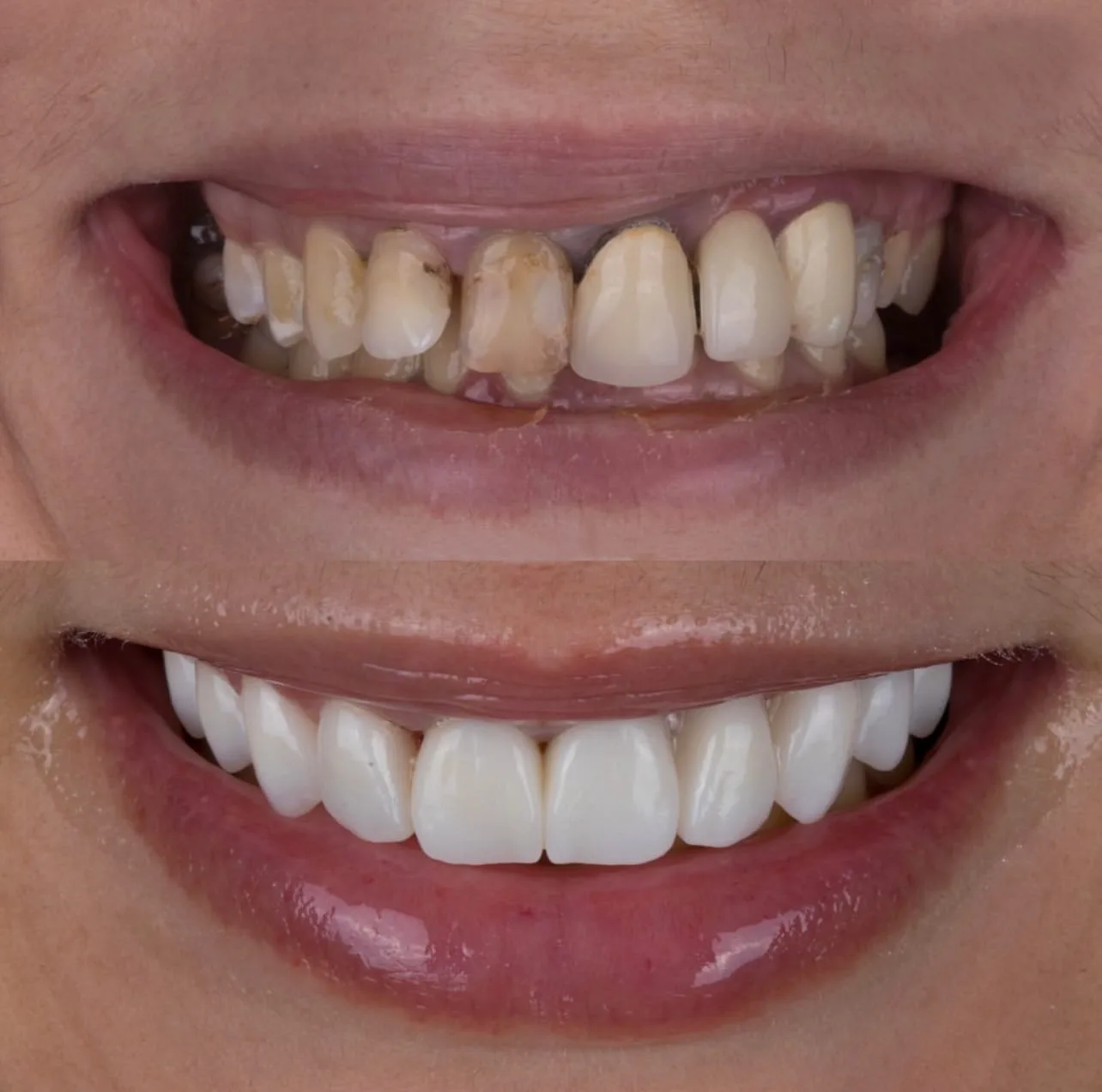 Lentes e coroas - antes e depois