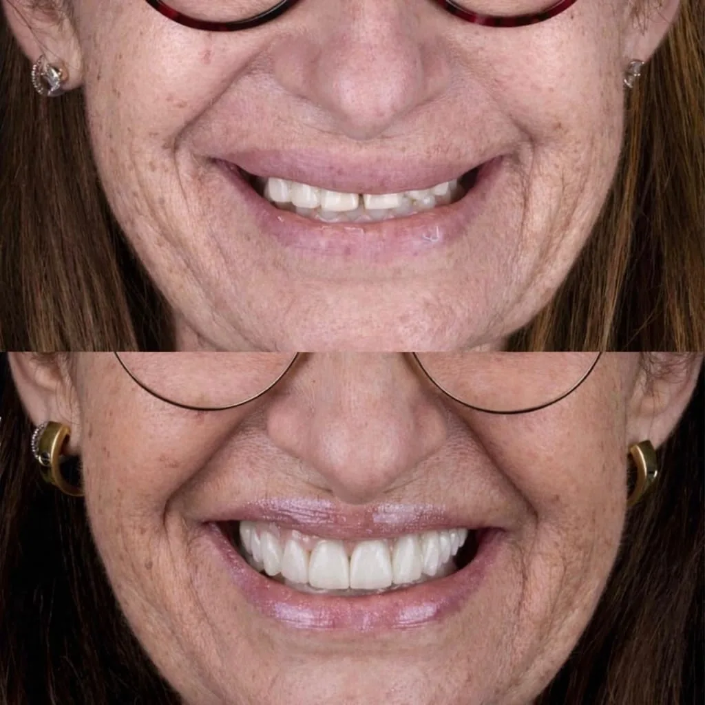 Lentes de contato dental - antes e depois