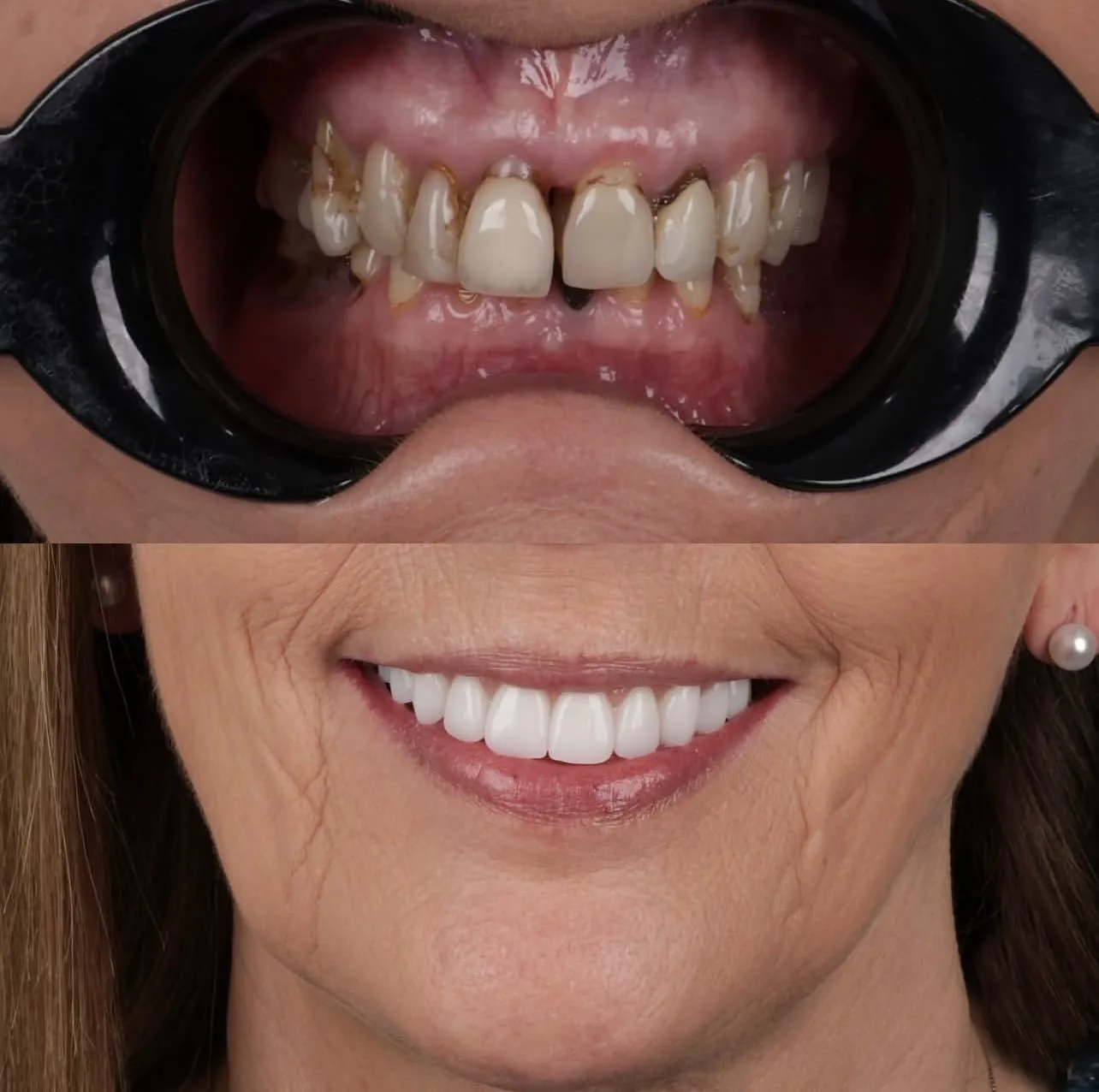 Lentes e coroas - antes e depois