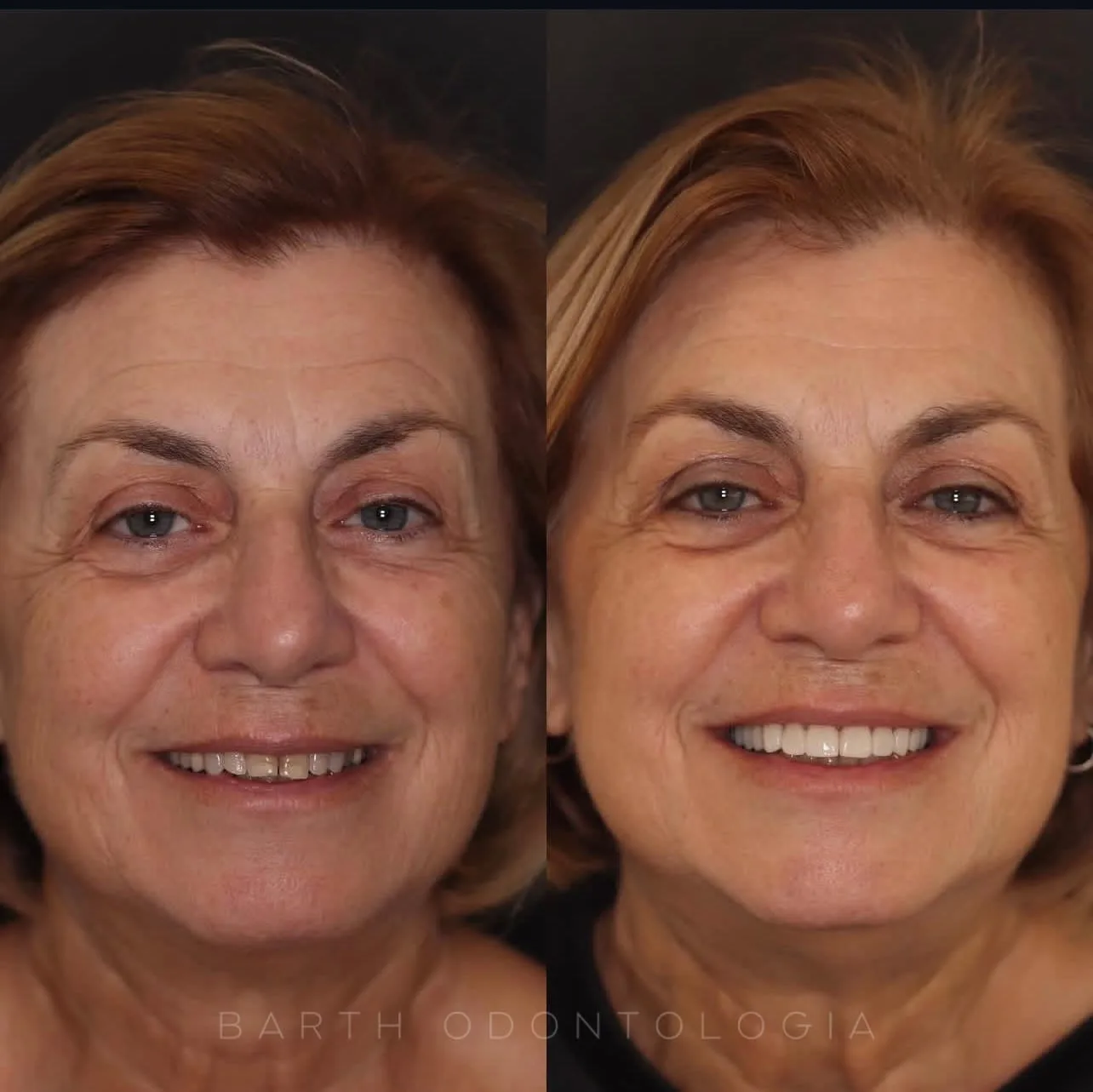 Lentes e coroas - antes e depois