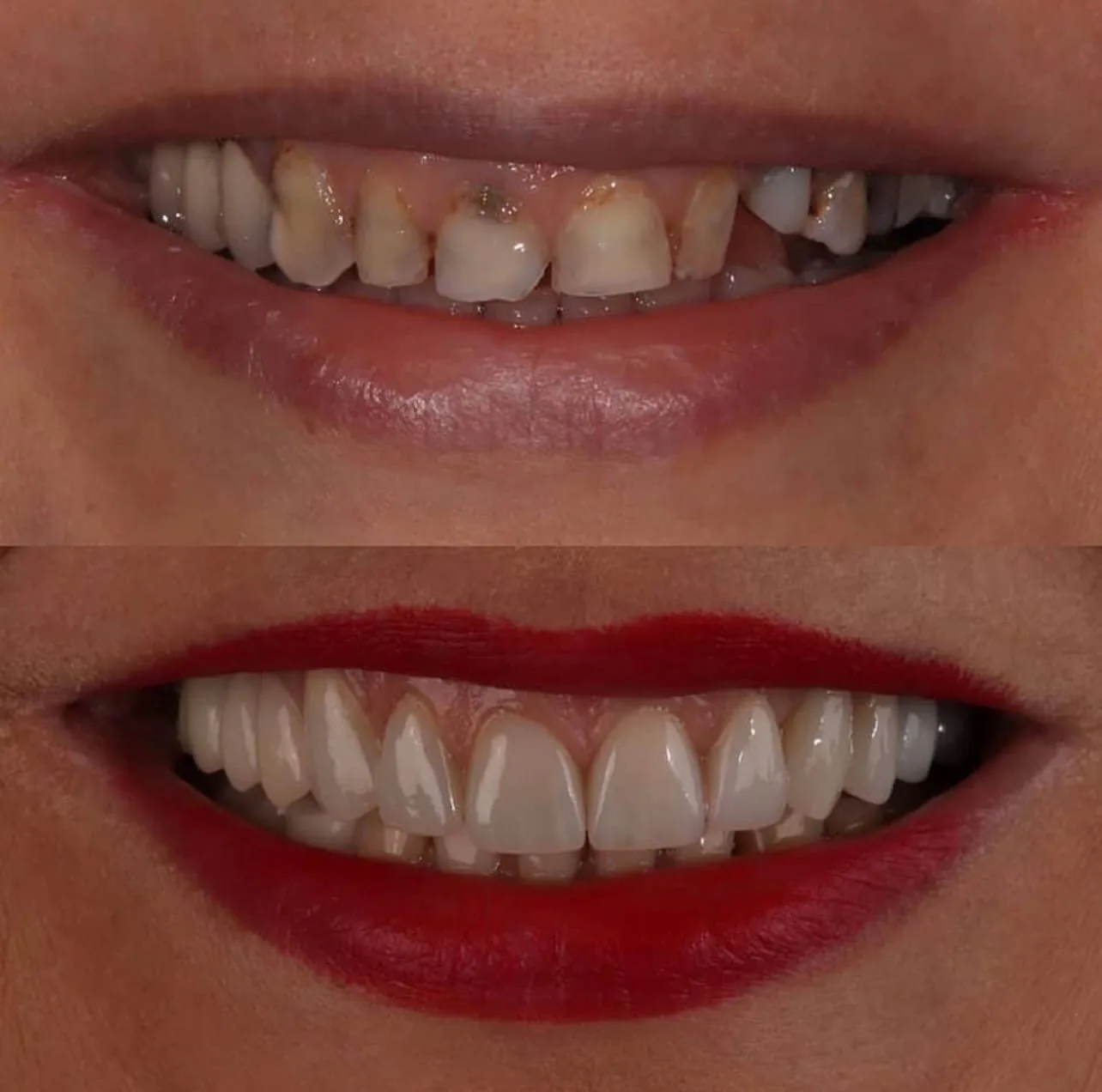 Lentes e coroas - foto intraoral