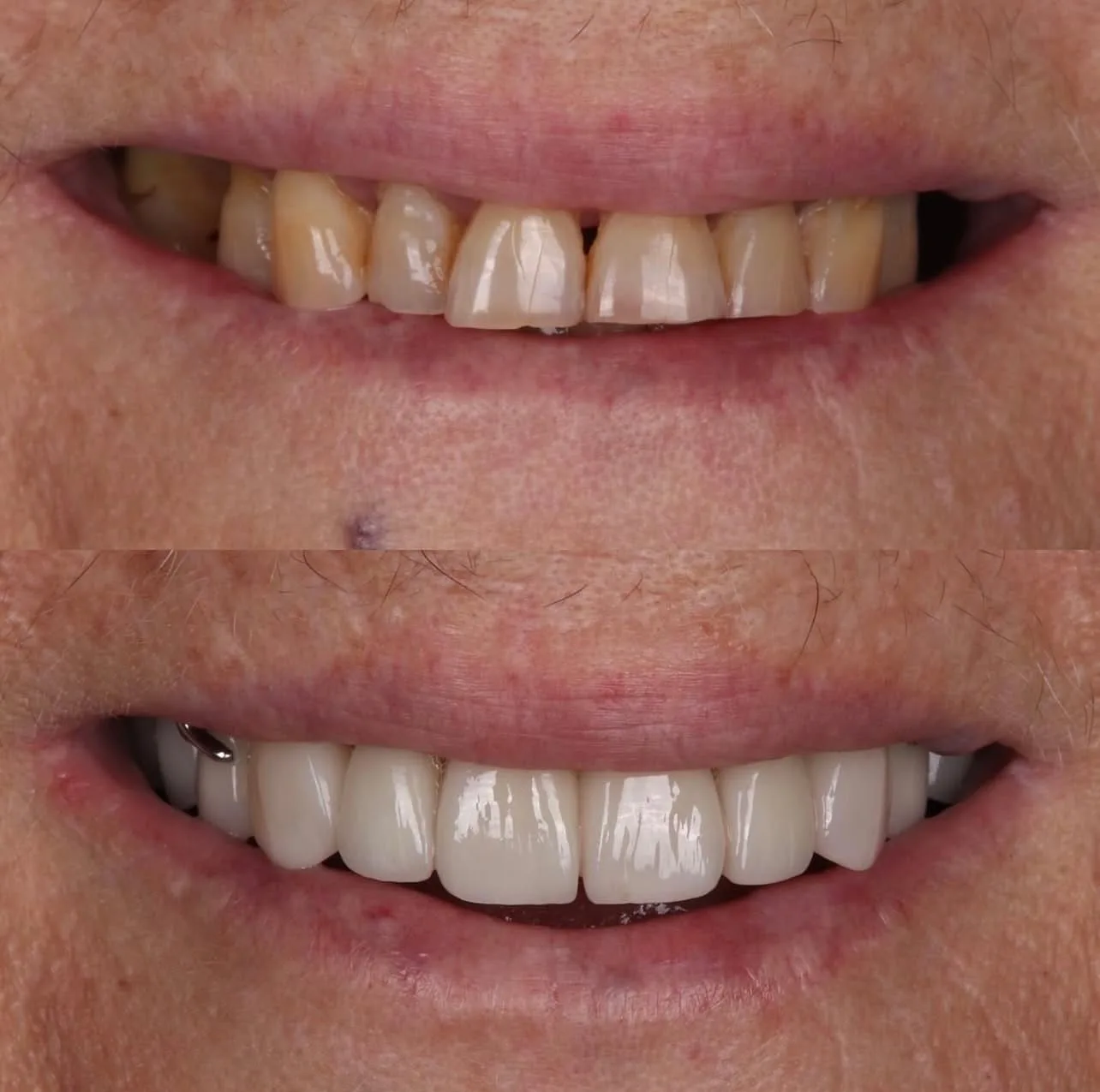 Lentes e PPR - antes e depois