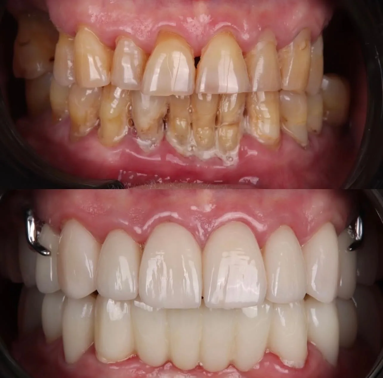 PPR, lentes e coroas - antes e depois