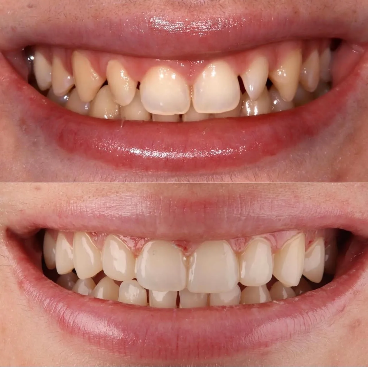 Lentes de contato dental - antes e depois