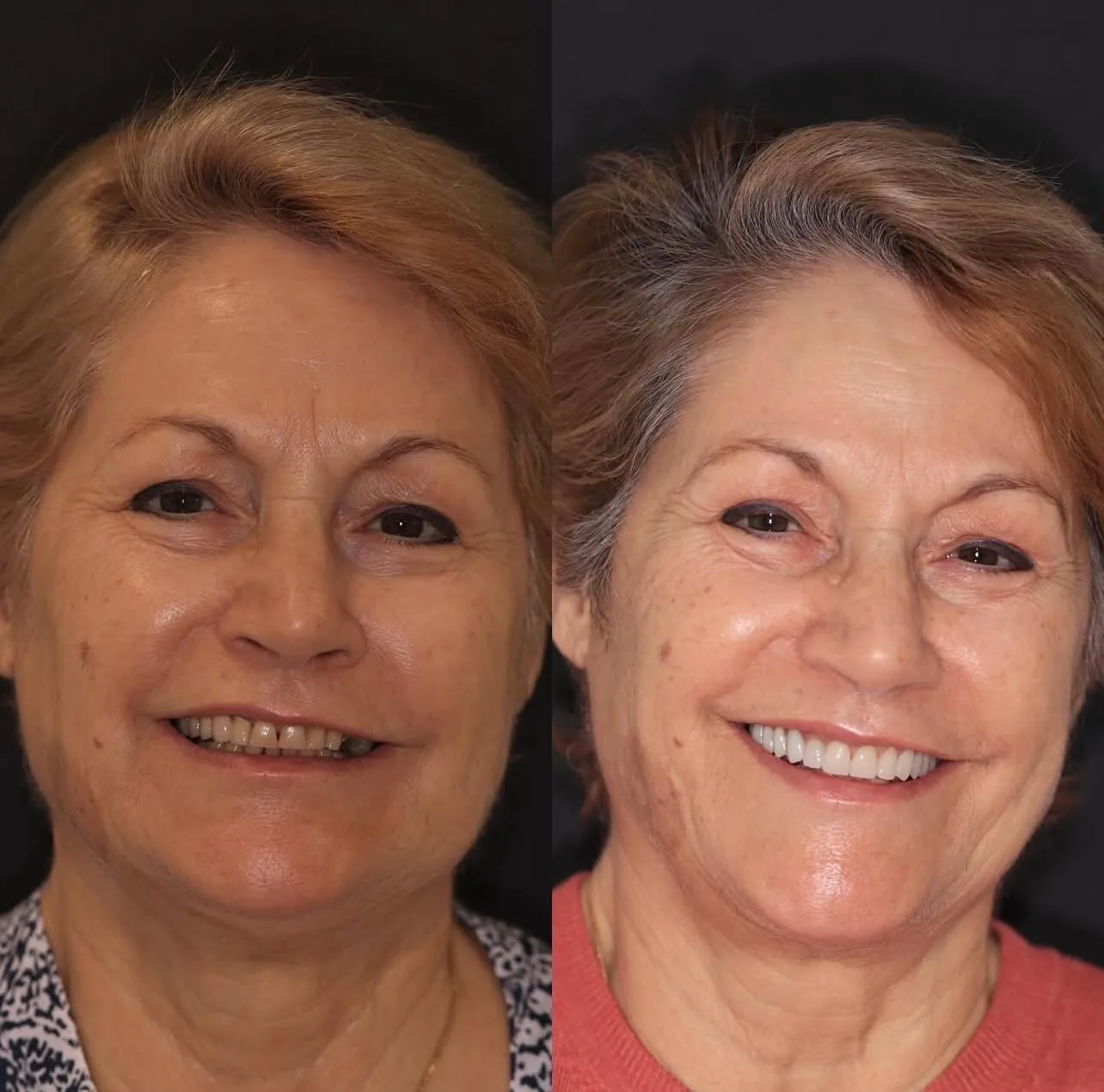 Lentes de contato dental - antes e depois