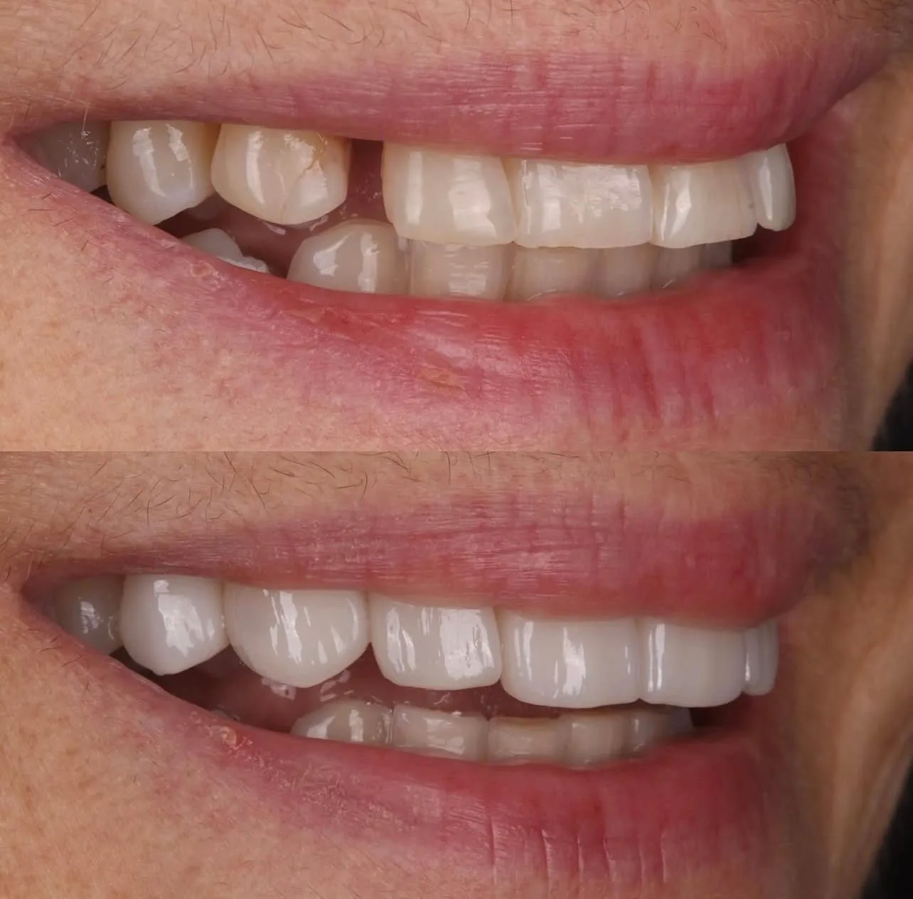 Lentes de contato dental - antes e depois