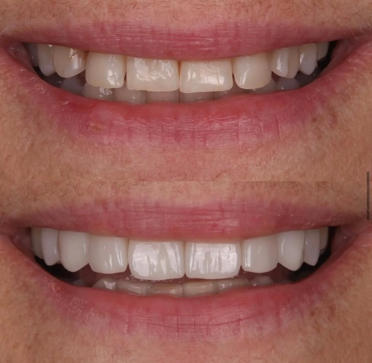 Lentes de contato dental - antes e depois