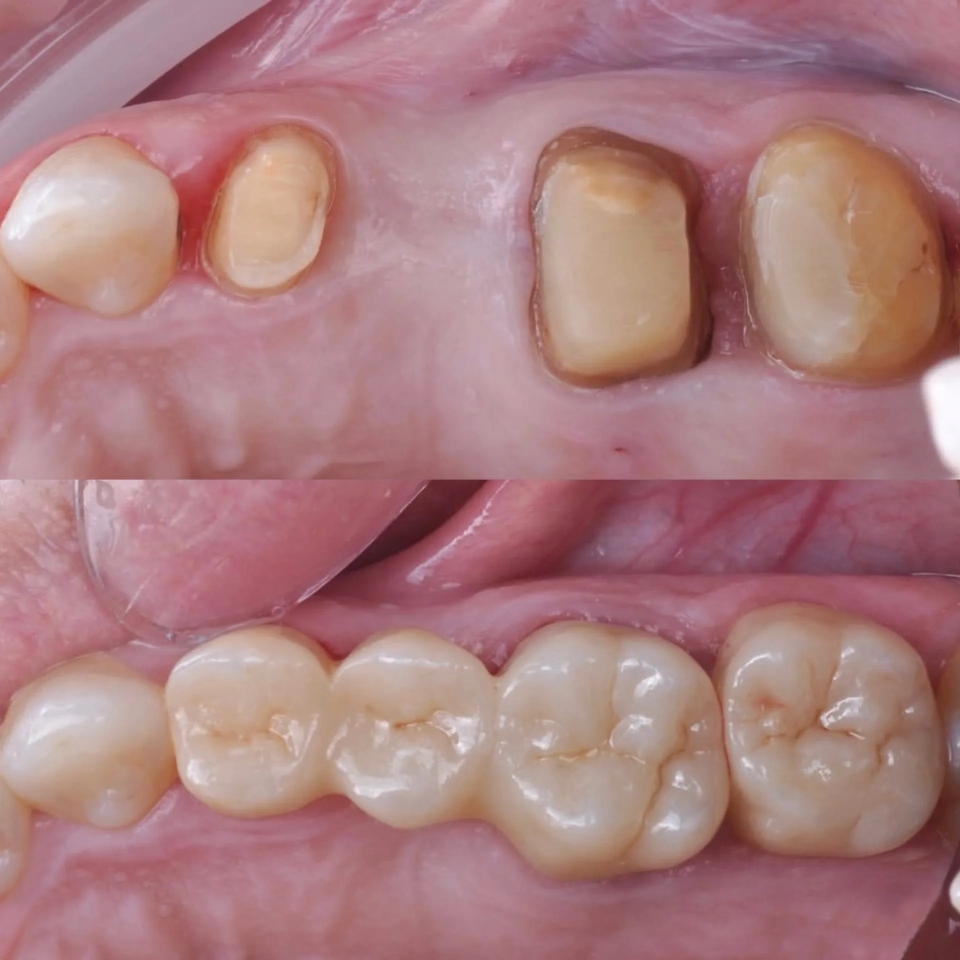 Ponte fixa - antes e depois