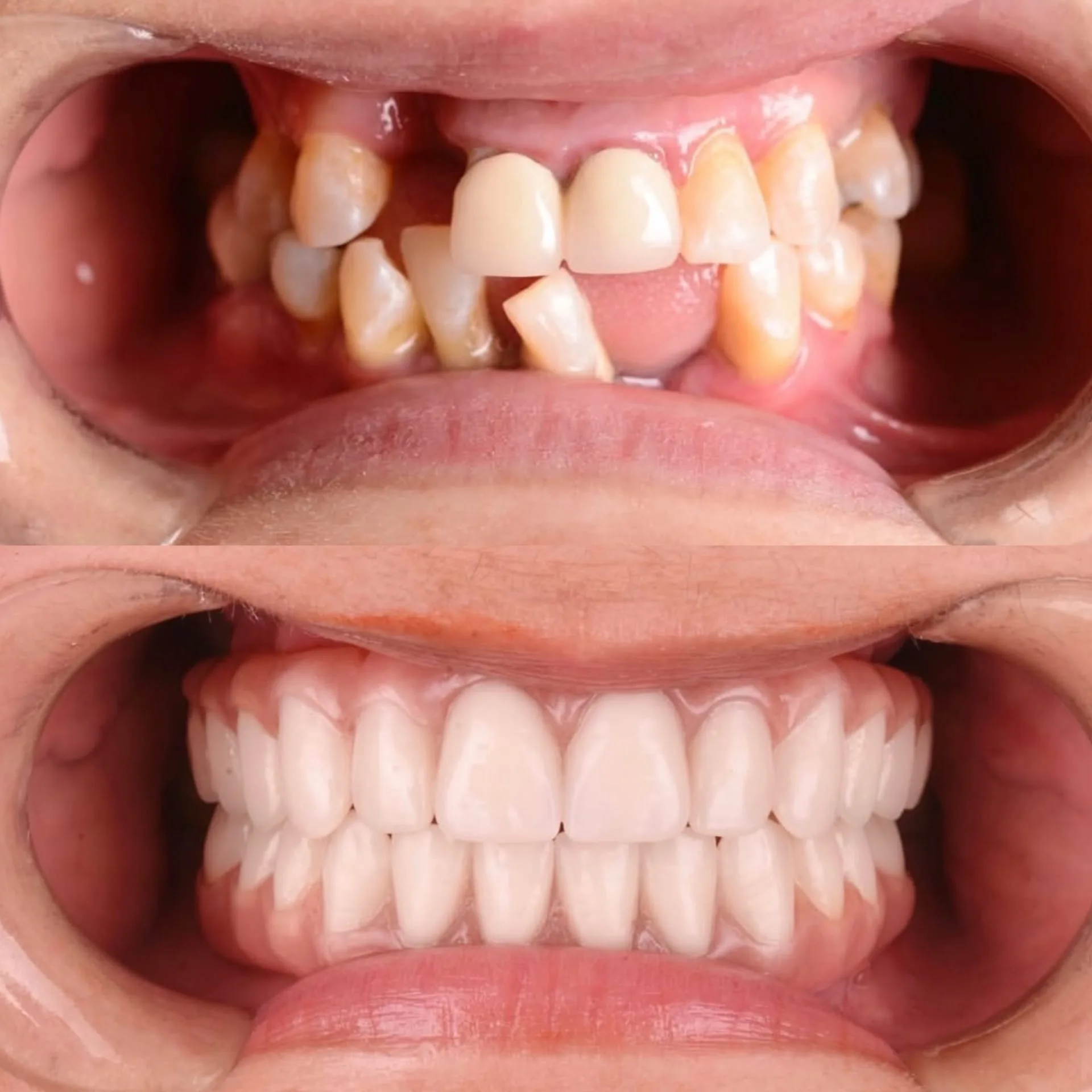 Protese protocolo - antes e depois