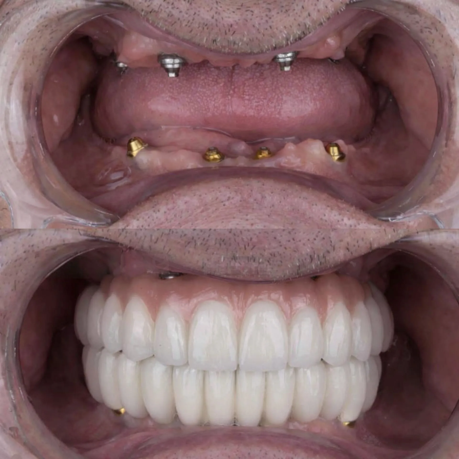 Protese protocolo - antes e depois