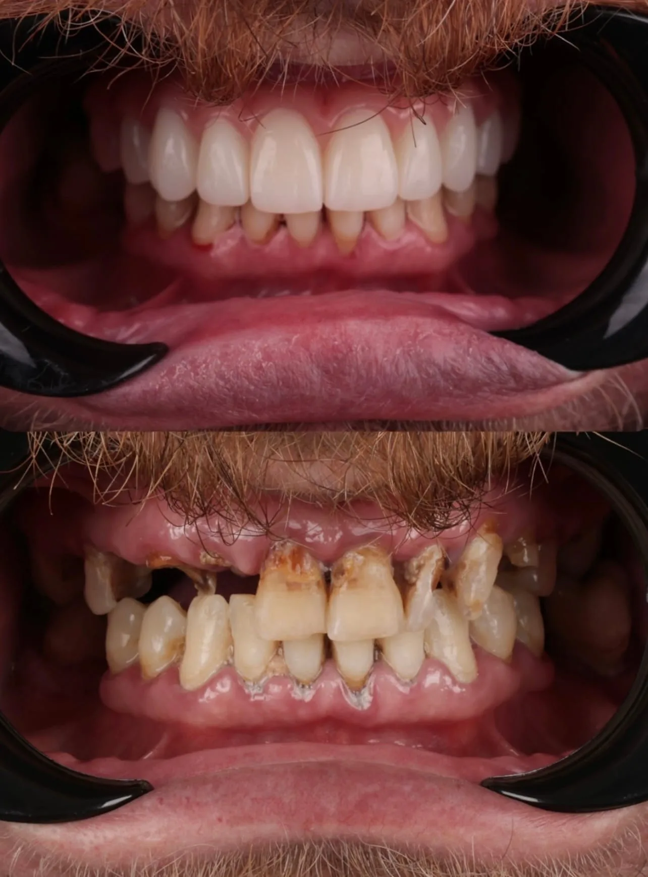 Protese protocolo - antes e depois