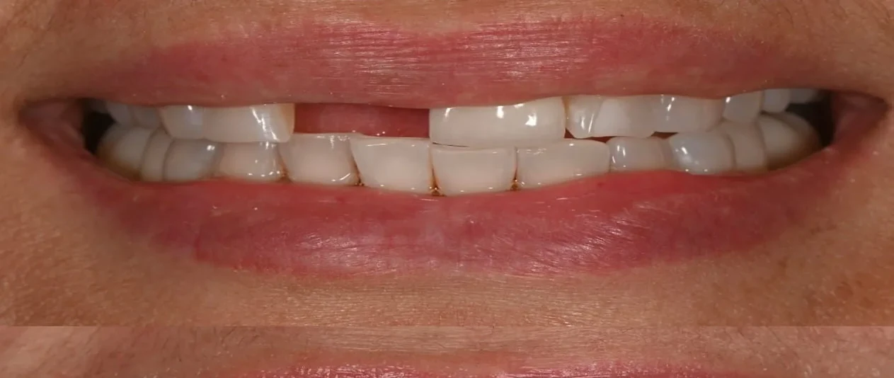 Resultado de implantes, antes do tratamento