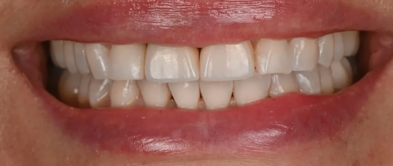 Resultado de implantes, depois do tratamento