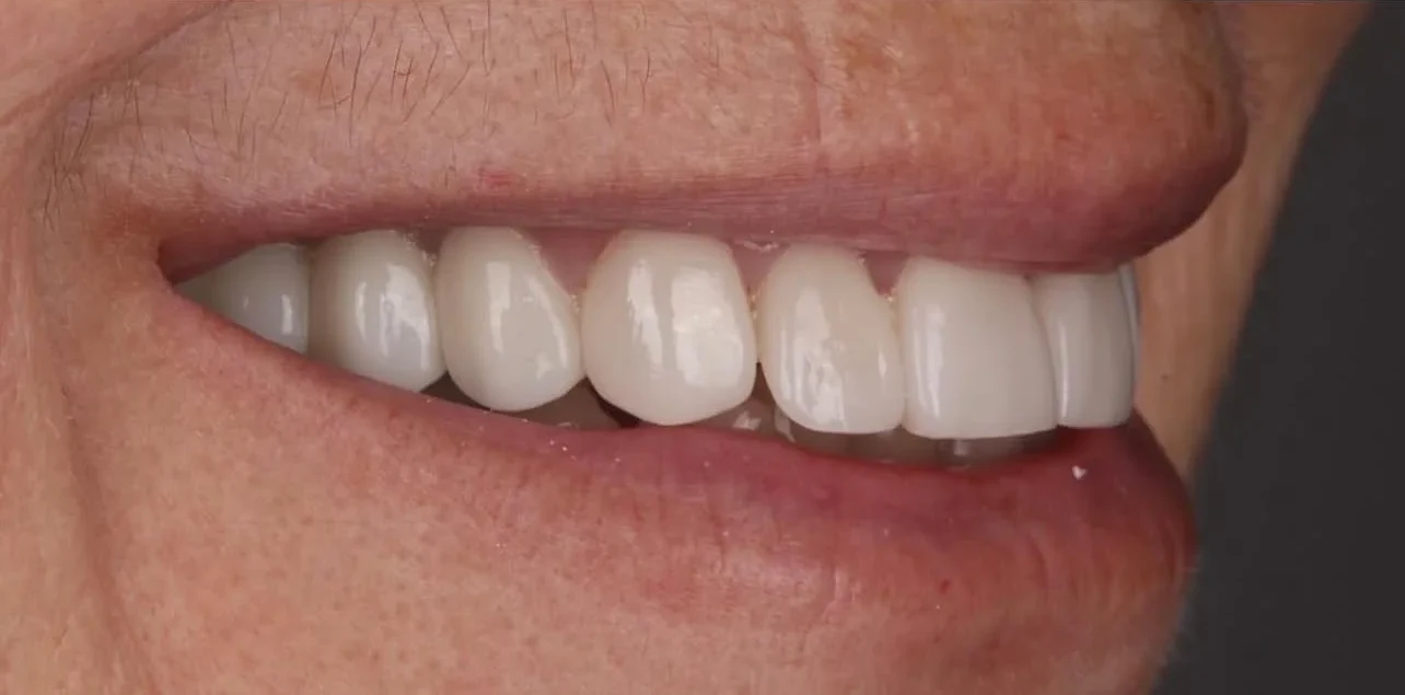 Resultado de lentes, depois do tratamento