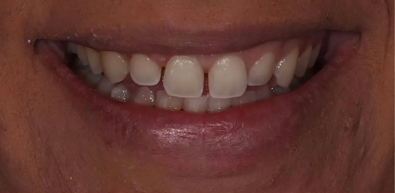 Resultado de lentes, antes do tratamento