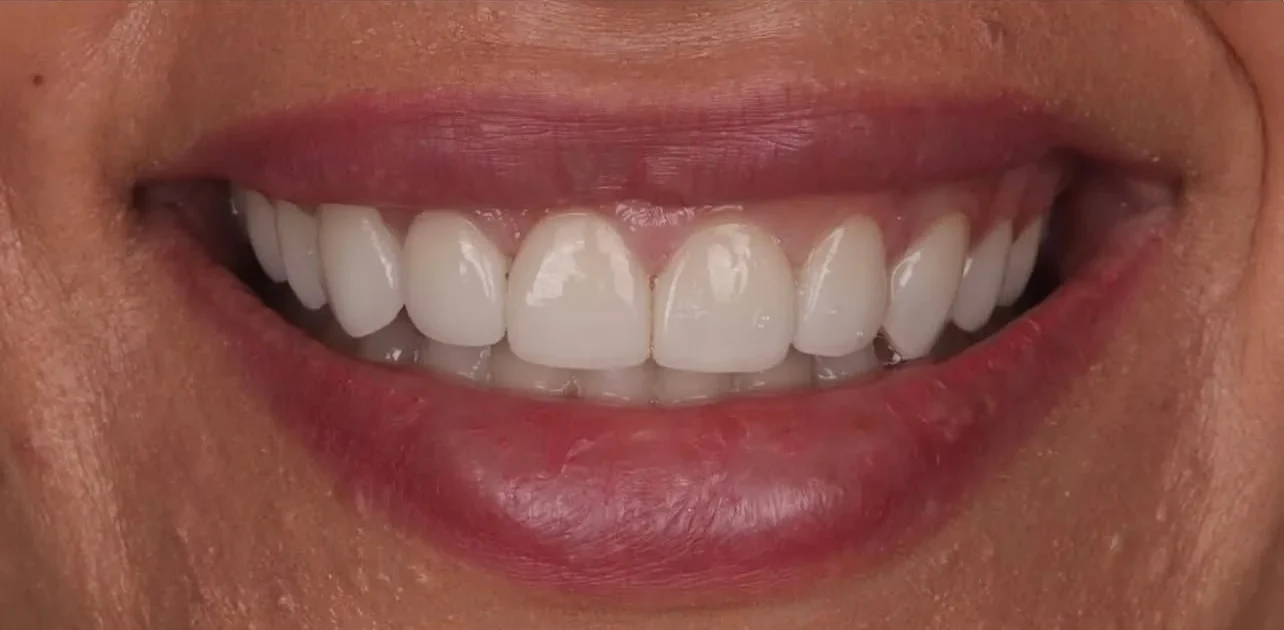 Resultado de lentes, depois do tratamento