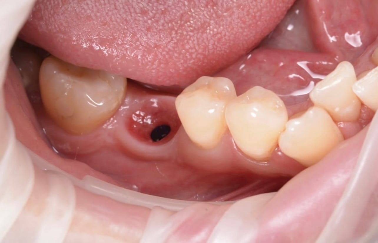 Resultado transformacao sorriso