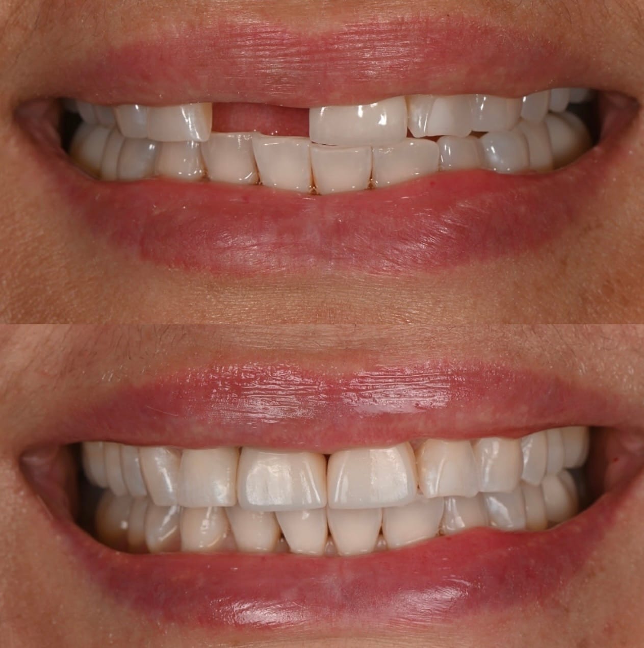 Resultado transformacao sorriso