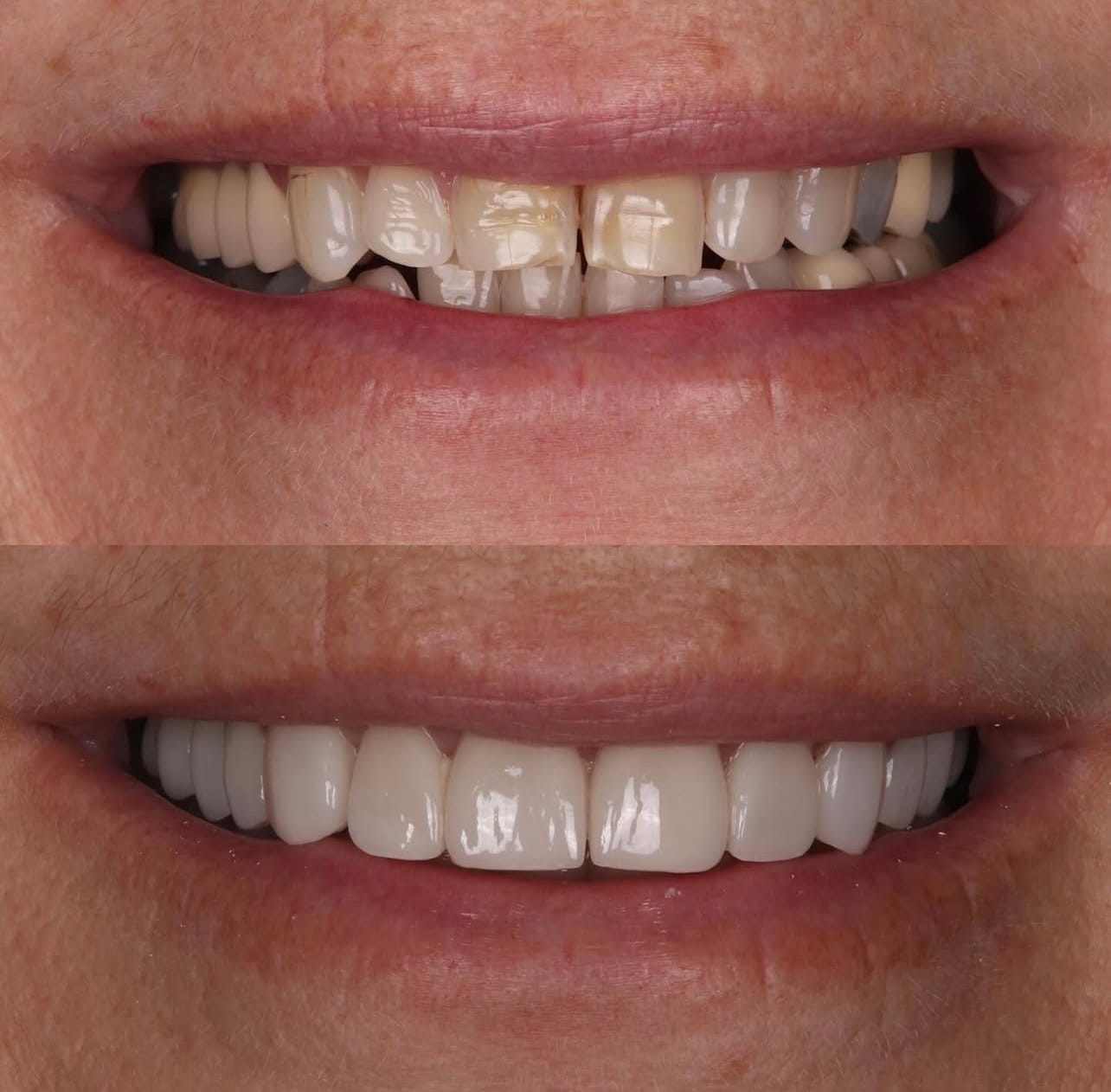 Resultado transformacao sorriso