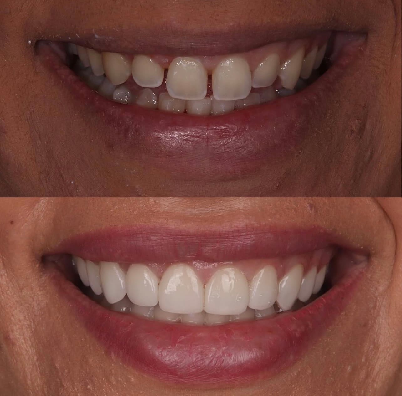Resultado proteses-dentarias