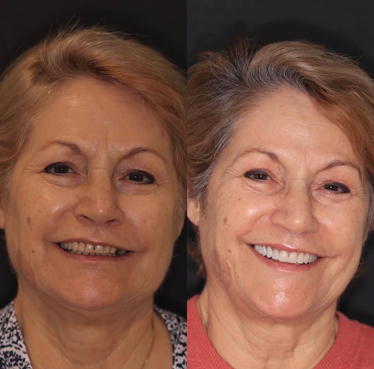 Resultado implantes-dentarios