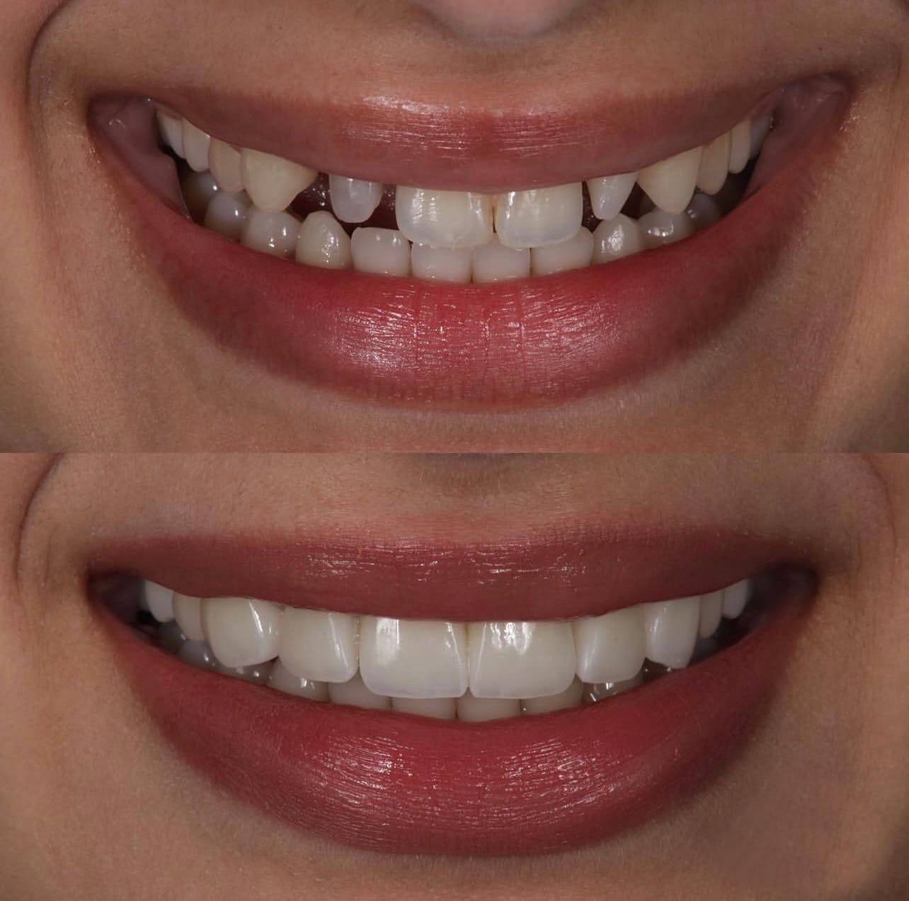 Resultado transformacao sorriso