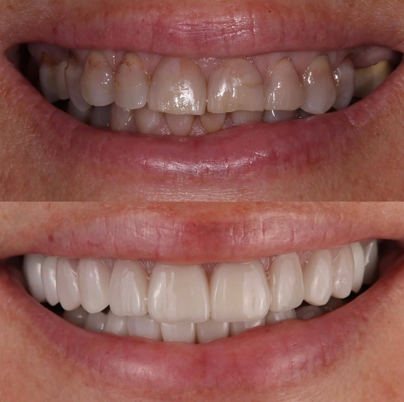 Resultado implantes-dentarios