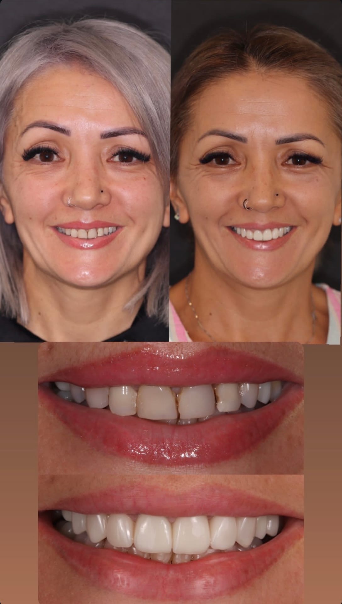 Resultado proteses-dentarias