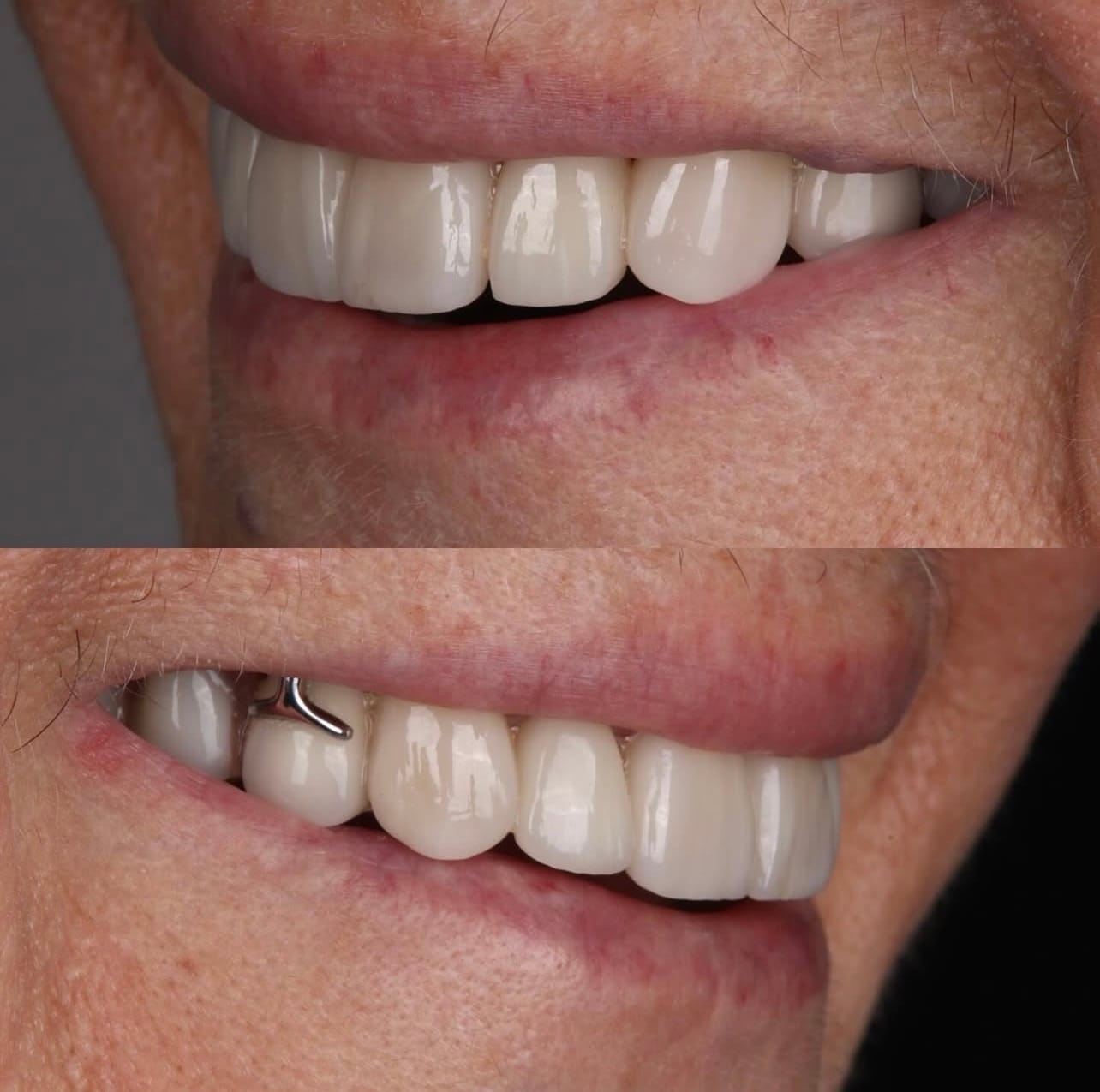 Resultado proteses-dentarias