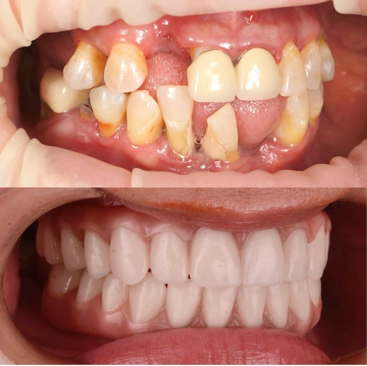Resultado proteses-dentarias