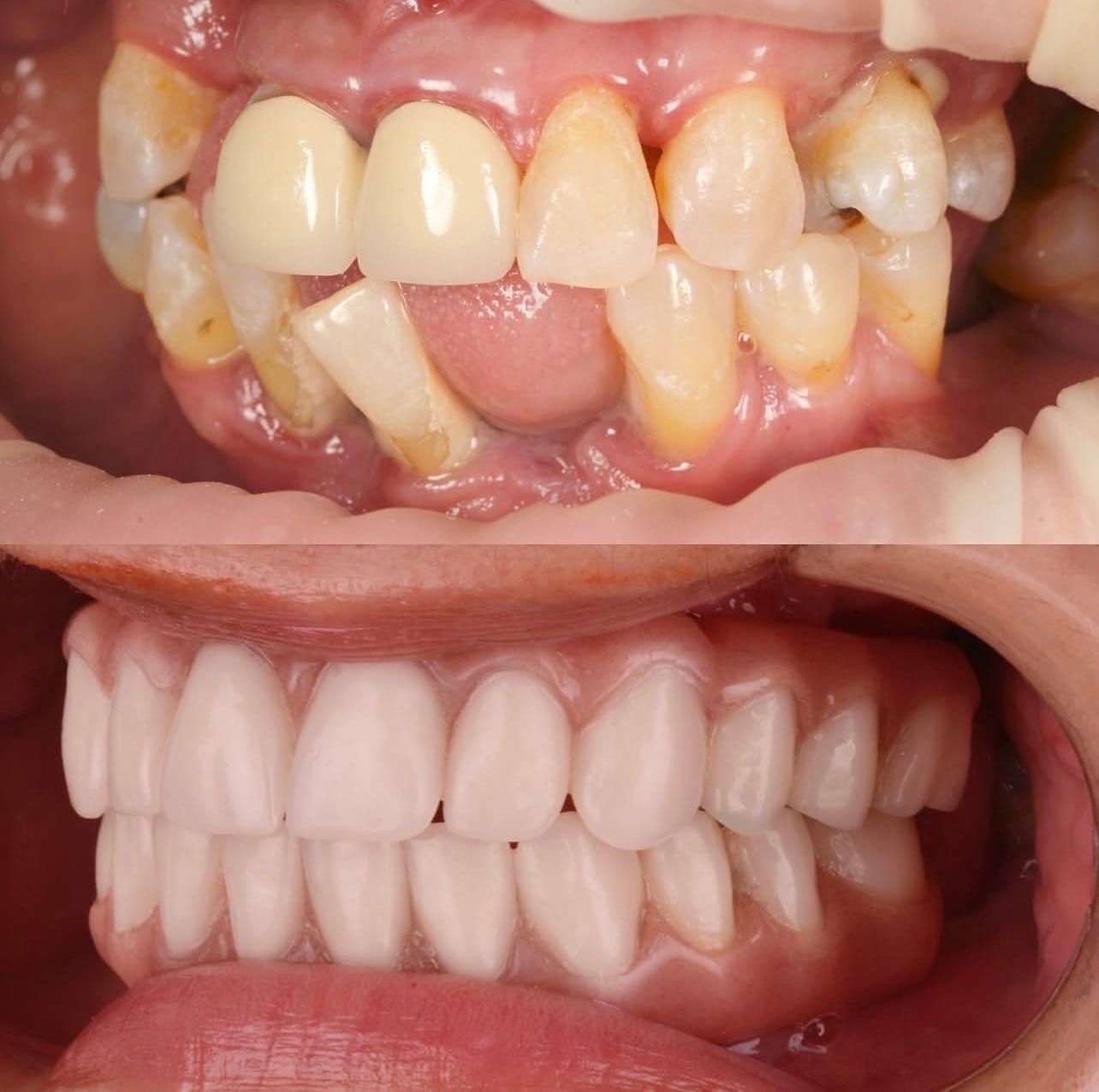 Resultado proteses-dentarias