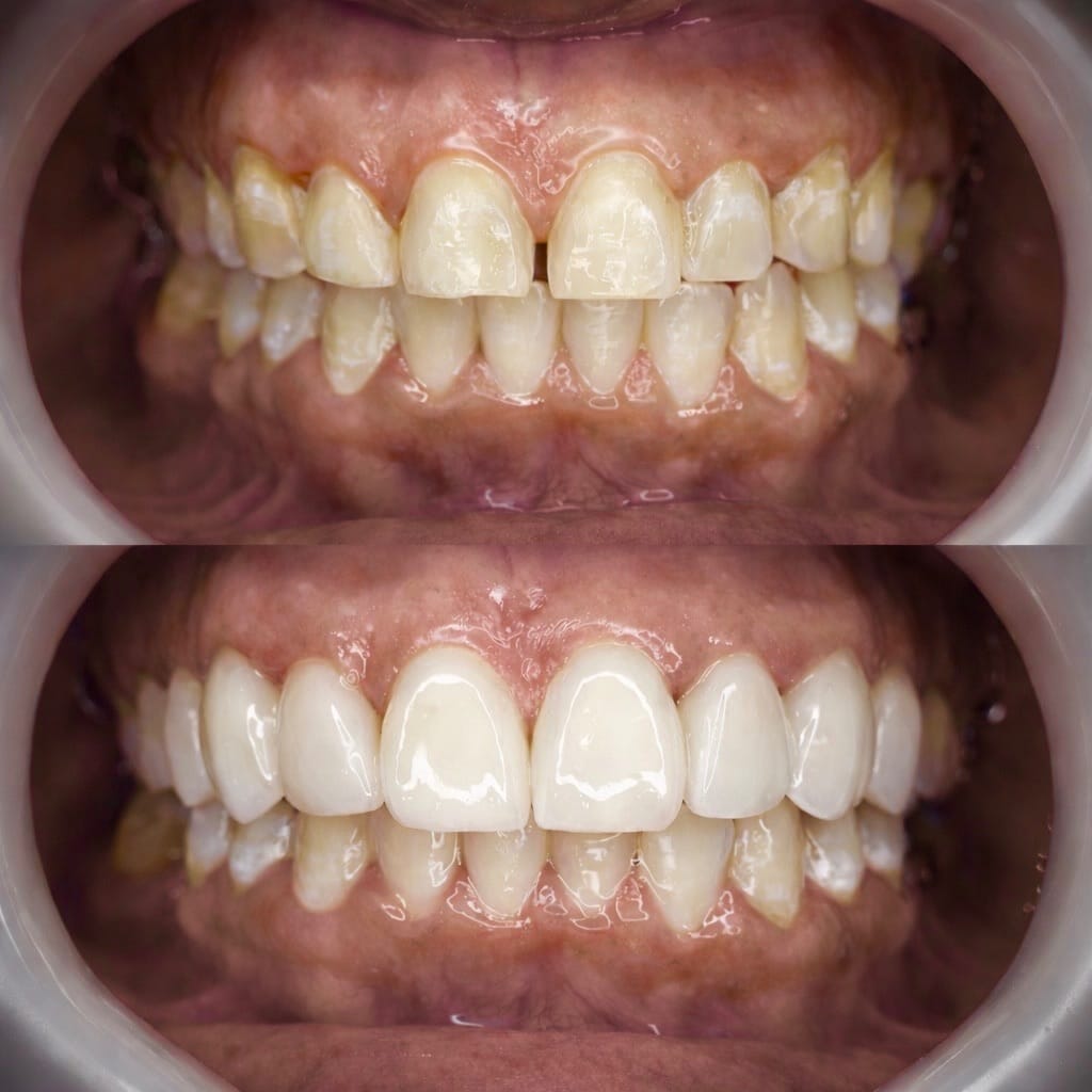 Resultado transformacao sorriso