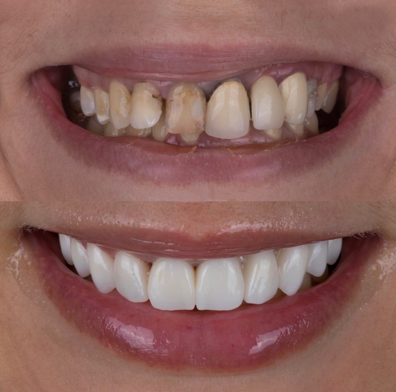 Resultado transformacao sorriso