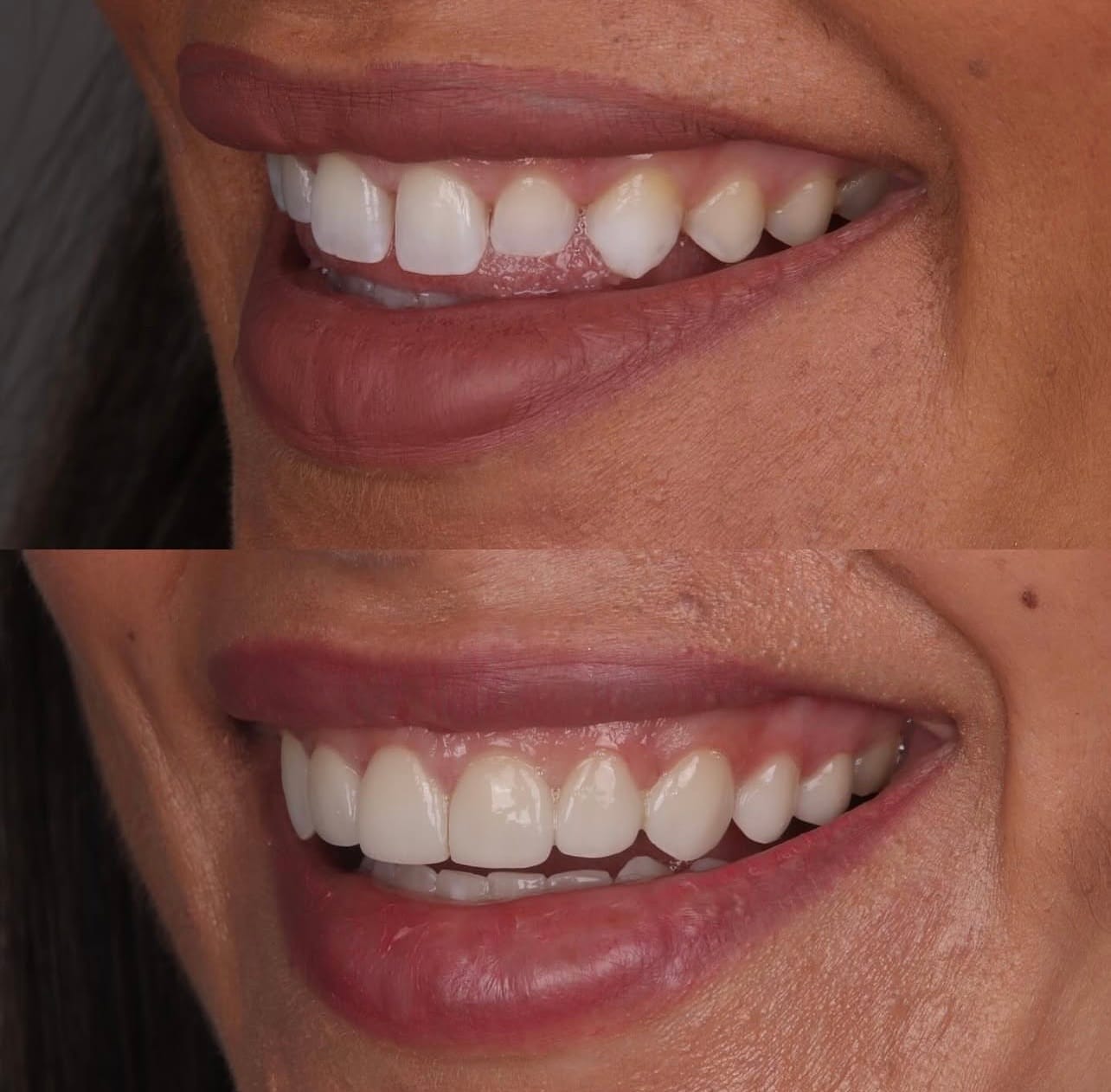 Facetas de Resina