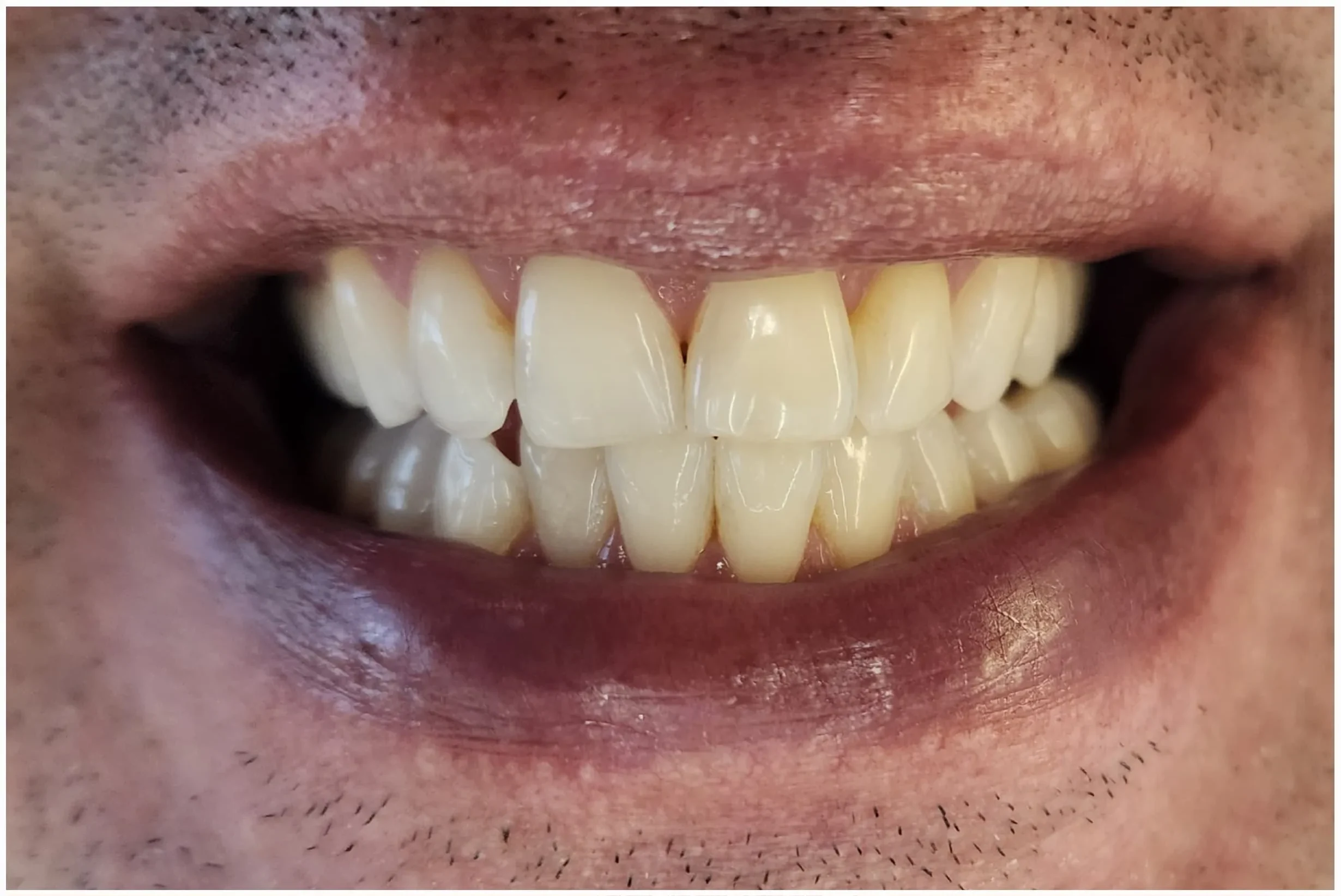 Resultado de clareamento antes depois, antes do tratamento