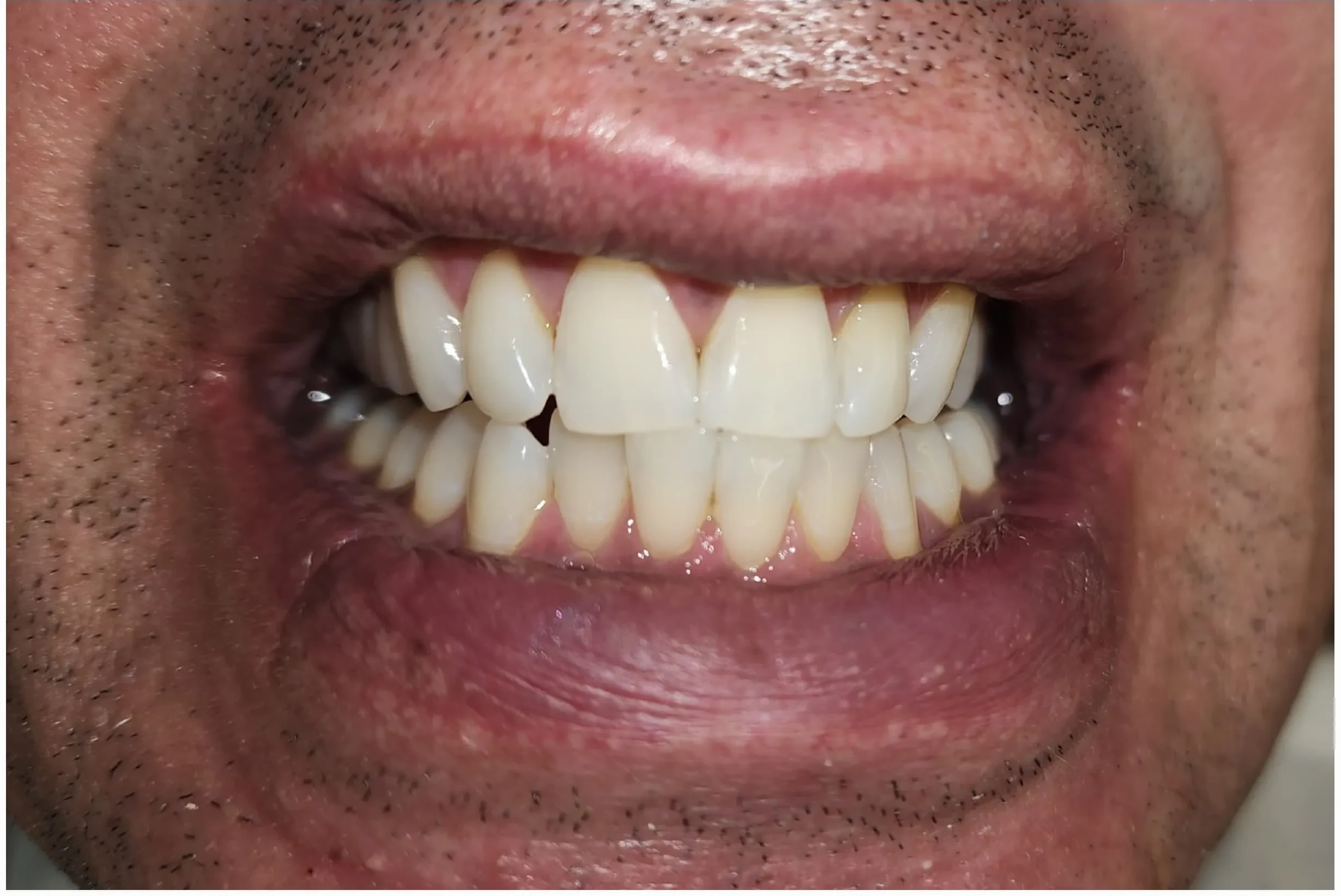 Resultado de clareamento antes depois, depois do tratamento