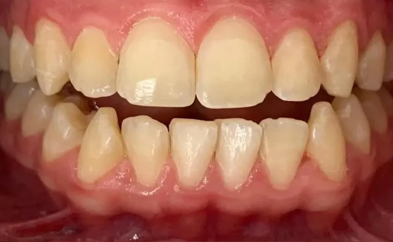Resultado de clareamento antes depois, antes do tratamento