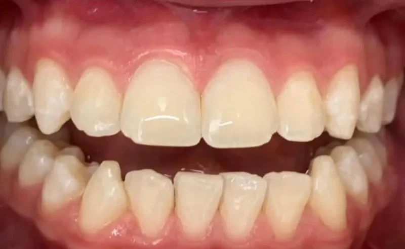 Resultado de clareamento antes depois, depois do tratamento
