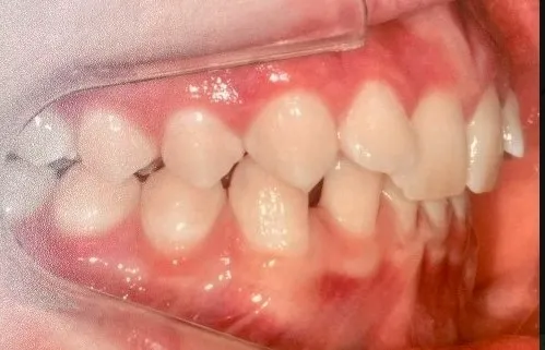 Antes - Invisalign 3