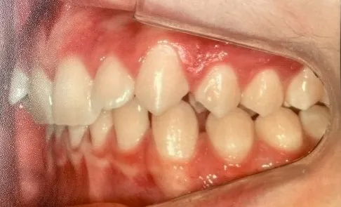 Antes - Invisalign 4