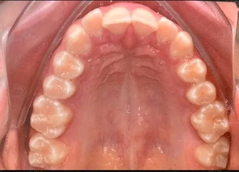 Antes - Invisalign 5