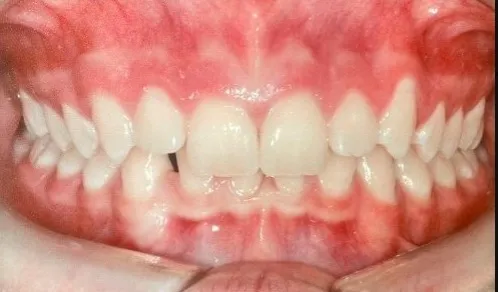 Antes - Invisalign 2