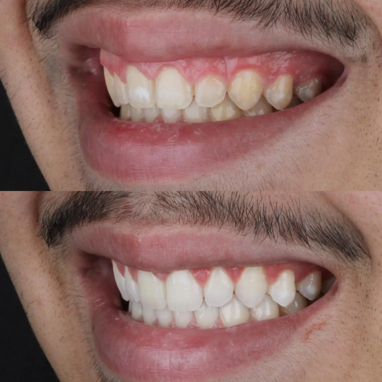 Antes e Depois - Clareamento Dental