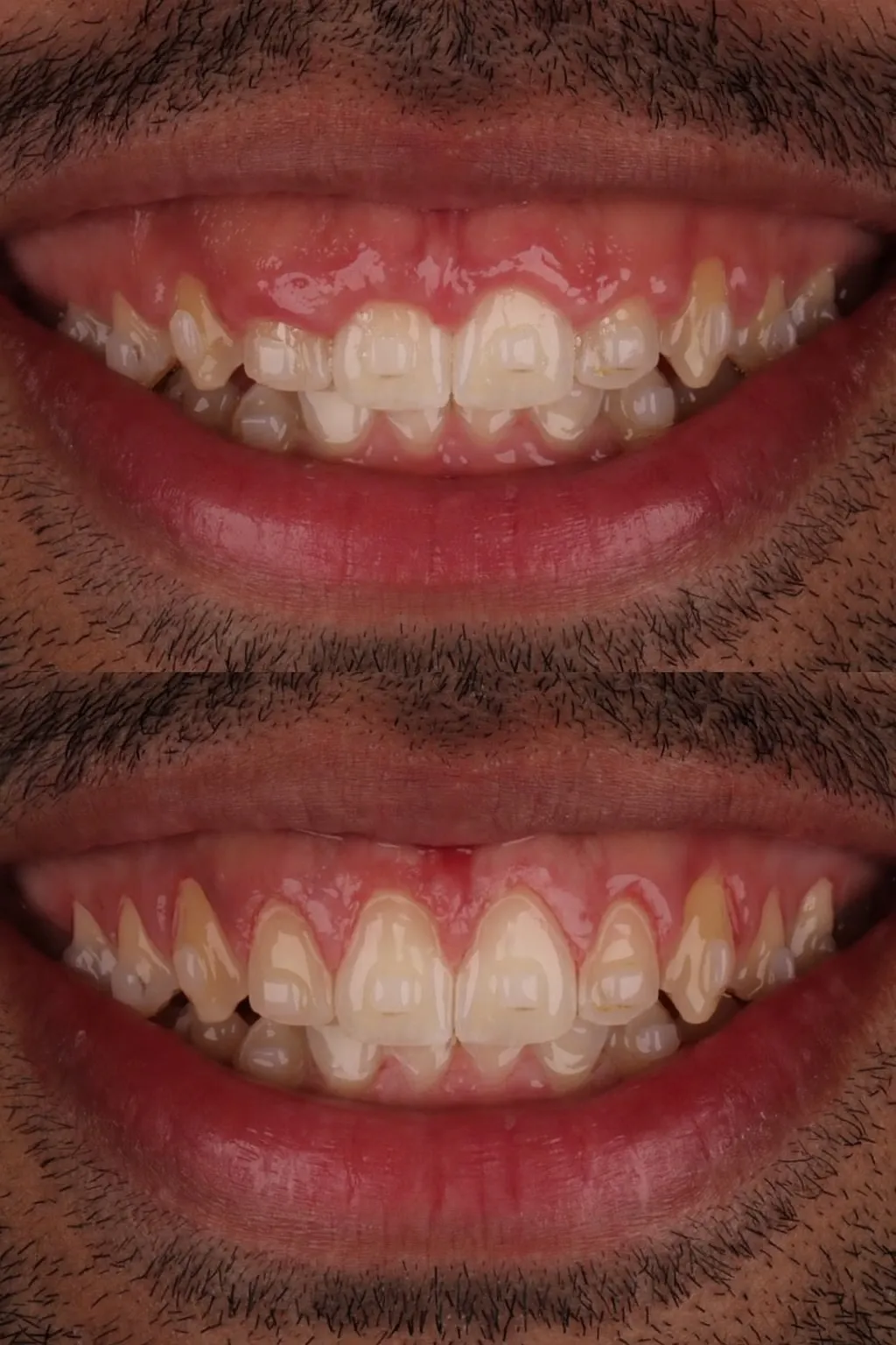 Antes e Depois - Gengivoplastia