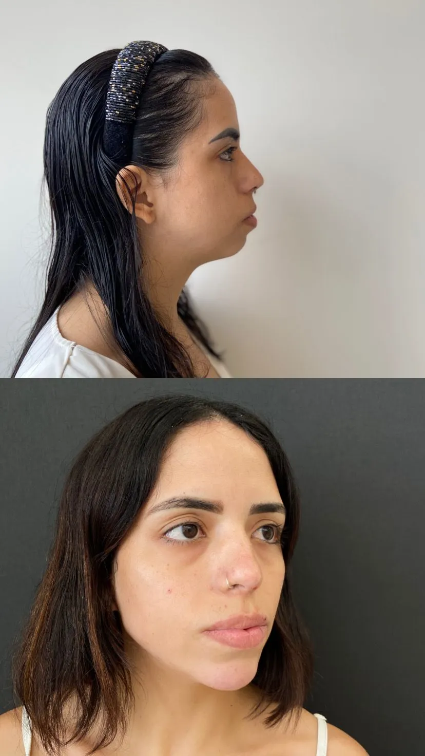 Antes e Depois - Harmonização Orofacial